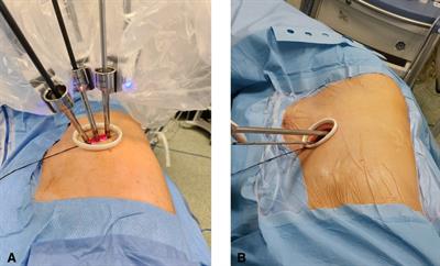 Early experience with uniportal robotic thoracic surgery lobectomy